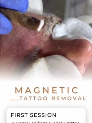 👀 Look at all that ink removed! 🪄  First Session using 🧲𝗠𝗮𝗴𝗻𝗲𝘁𝗶𝗰 𝗧𝗮𝘁𝘁𝗼𝗼...