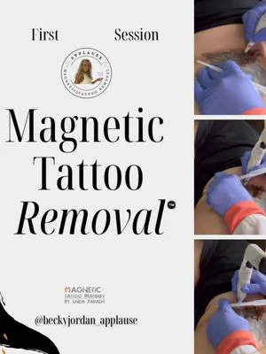 First Session using 🧲𝗠𝗮𝗴𝗻𝗲𝘁𝗶𝗰 𝗧𝗮𝘁𝘁𝗼𝗼 𝗥𝗲𝗺𝗼𝘃𝗮𝗹™️ to remove lower back...