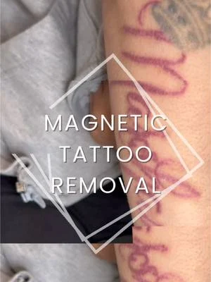 What an Initial Consultation looks like: my client has a 7/8 years old tattoo & has had laser...