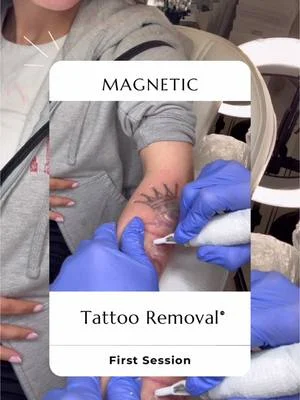 ✅First Session ✅ 🧲𝗠𝗮𝗴𝗻𝗲𝘁𝗶𝗰 𝗧𝗮𝘁𝘁𝗼𝗼 𝗥𝗲𝗺𝗼𝘃𝗮𝗹™️ on an arm tattoo.